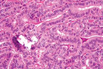Imagen: Micrografía de un carcinoma papilar de tiroides variante de células altas (Fotografía cortesía de Nephron).